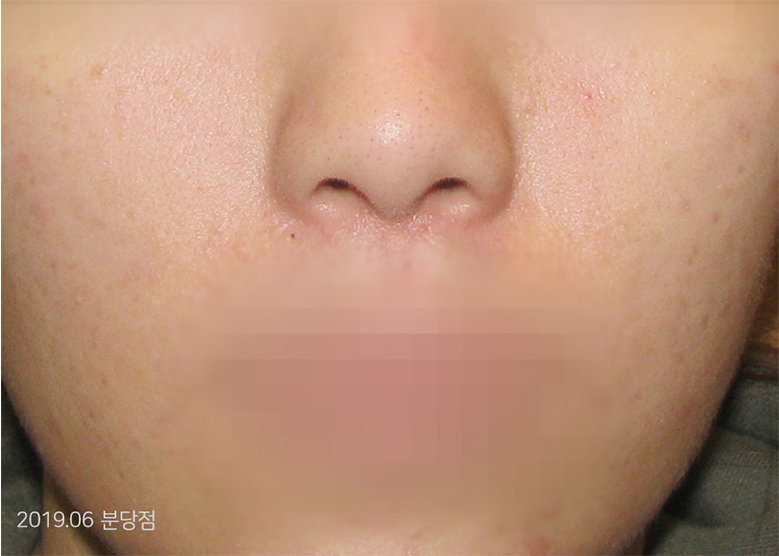 After Treatment of Seborrheic Dermatitis