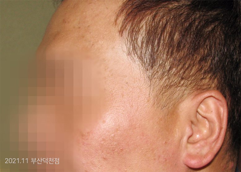 After Treatment of Seborrheic Dermatitis