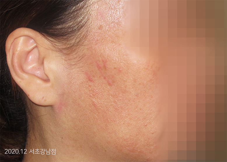 After Treatment of Seborrheic Dermatitis