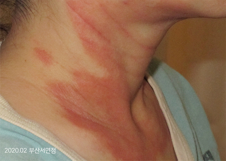 Before Treatment of Seborrheic Dermatitis