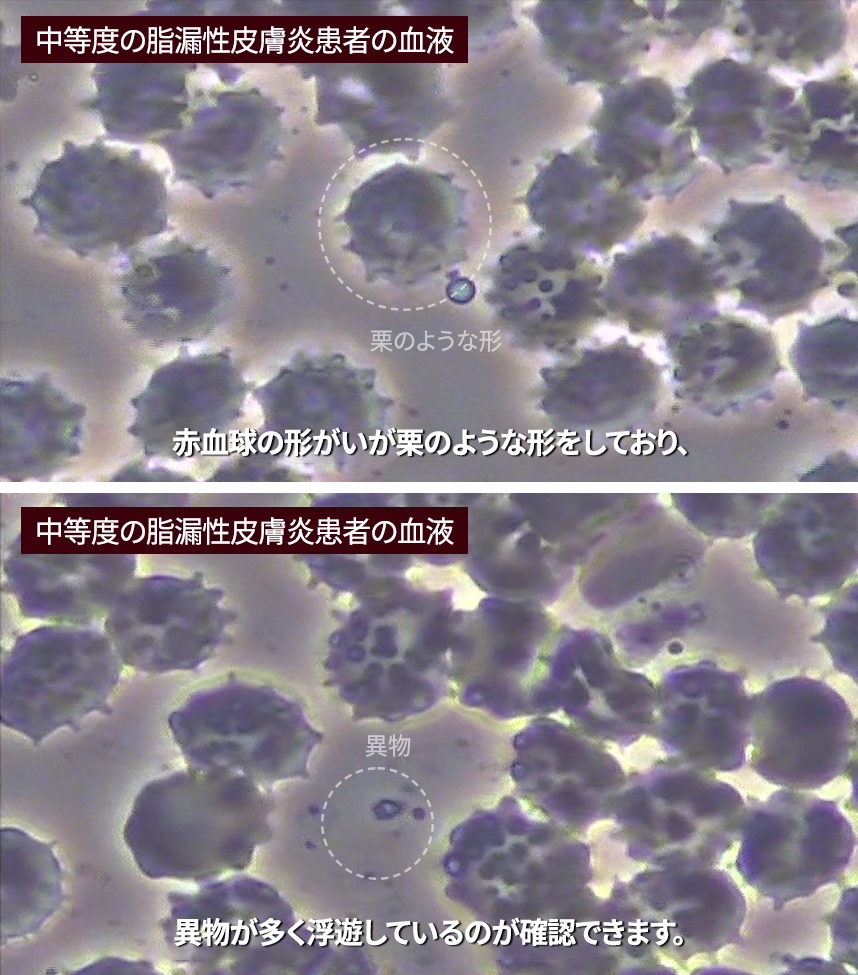 Blood of a patient with severe seborrheic dermatitis 