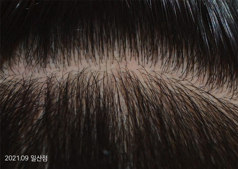 After Treatment of Seborrheic Dermatitis of the scalp
