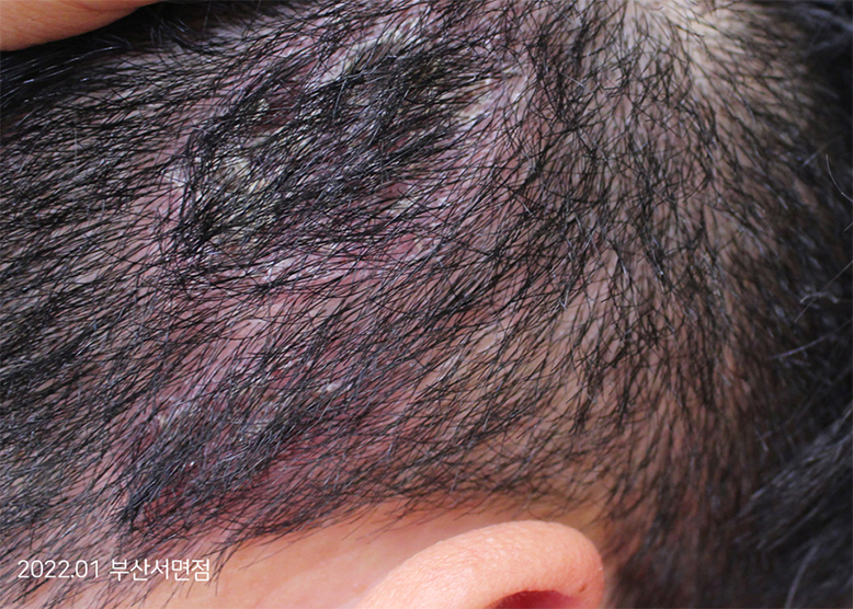 Before Treatment of Seborrheic Dermatitis of the scalp