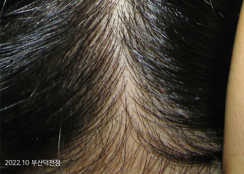 After Treatment of Seborrheic Dermatitis of the scalp