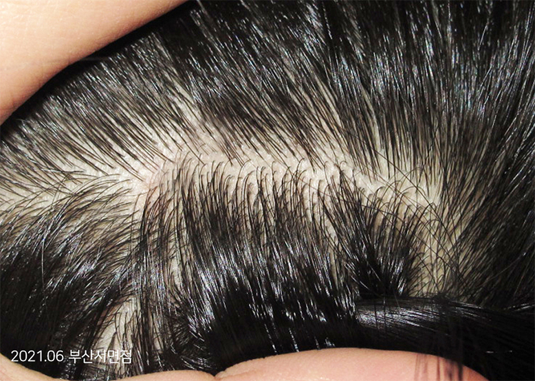 After Treatment of Seborrheic Dermatitis of the scalp