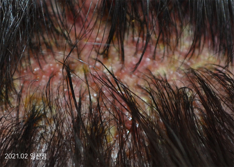 Before Treatment of Seborrheic Dermatitis of the scalp