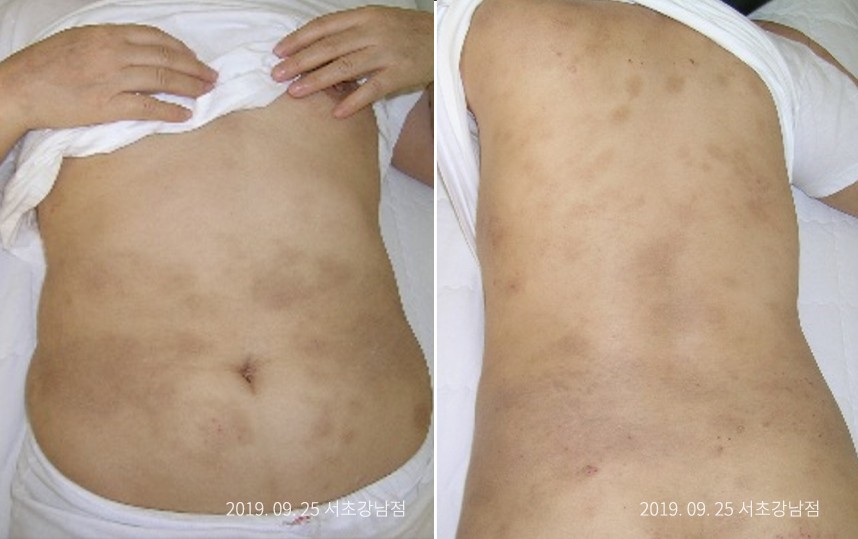 하늘마음한의원 청열 해독후 치료된 모습