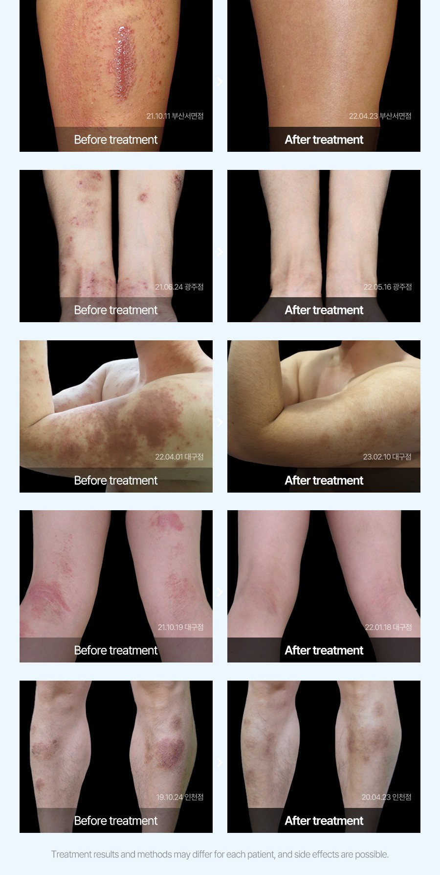 습진 치료 전후 사례