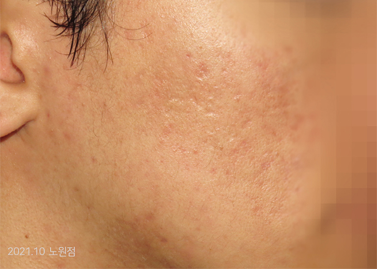 After Treatment of Acne