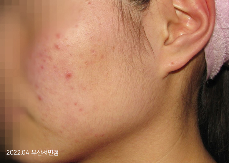 Before Treatment of Acne