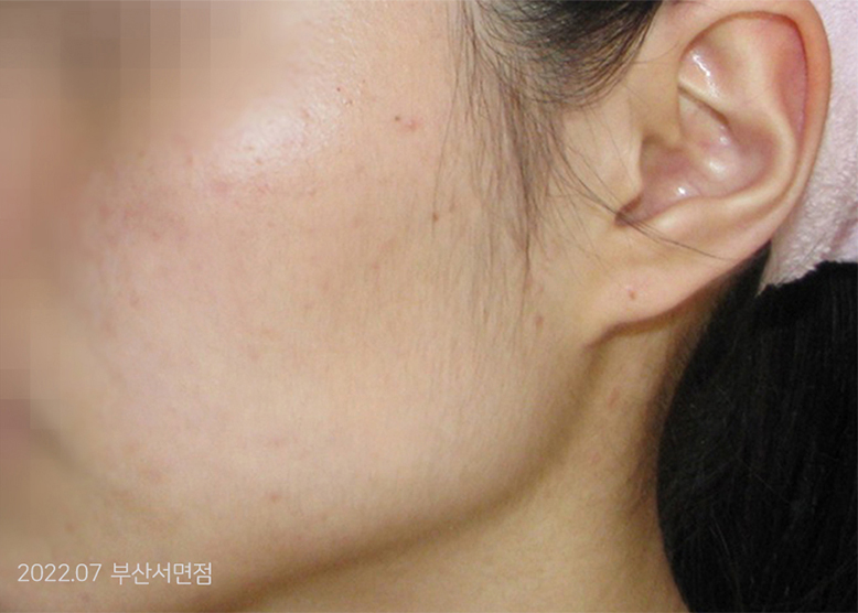 After Treatment of Acne