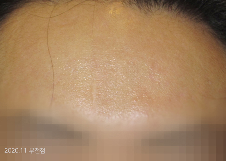After Treatment of Acne