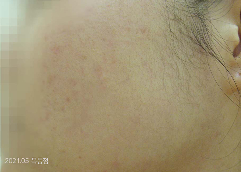 After Treatment of Acne