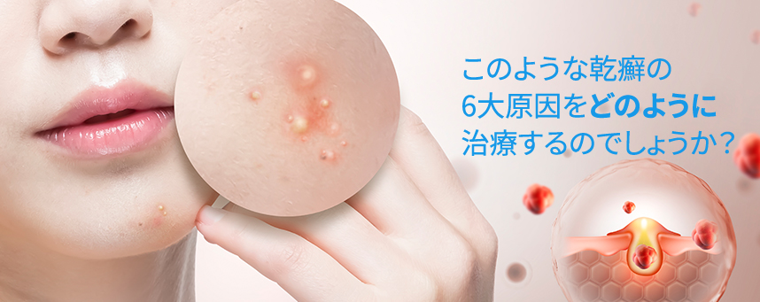 How do we treat these six major causes of acne? 