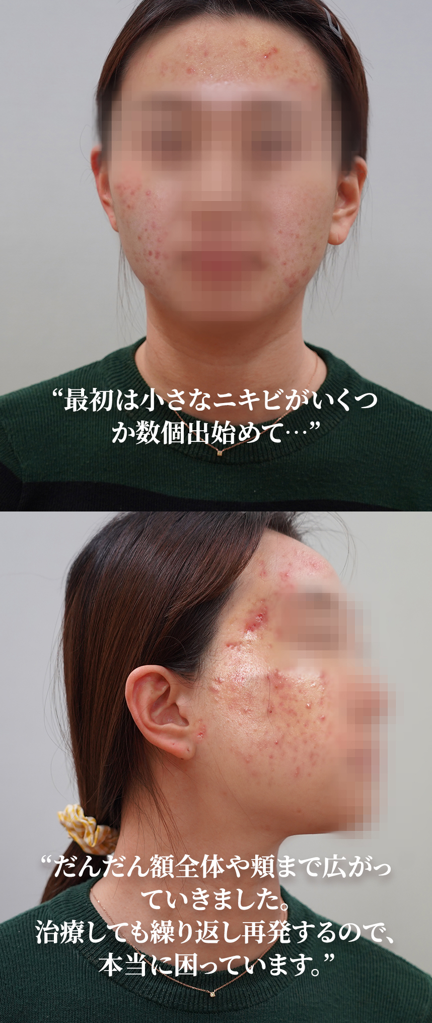 At first, I started getting a few small pimples, but... Eventually, they spread to my entire forehead and cheeks. Even though I’ve been getting treatment, they keep coming back, and it's driving me crazy.