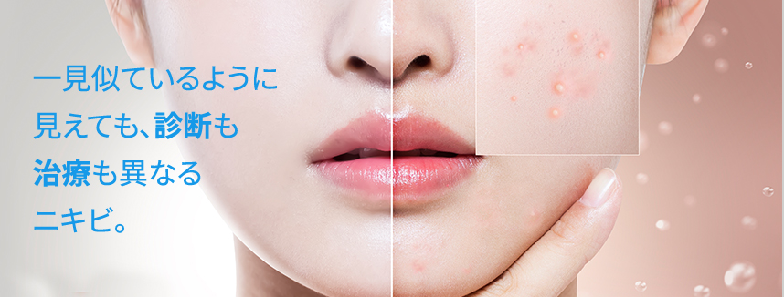 Acne may look similar, but have different diagnoses and treatments!