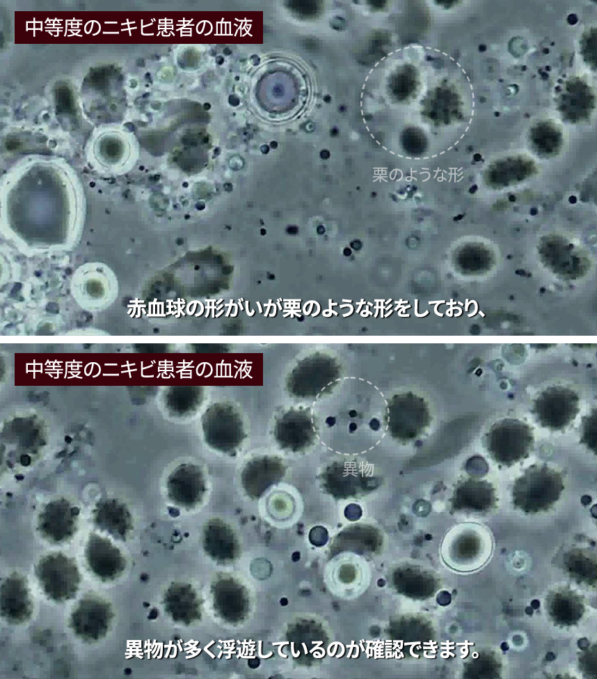 Blood of a patient with severe eczema 