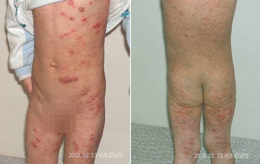 소아 아토피 병력 6년 남아