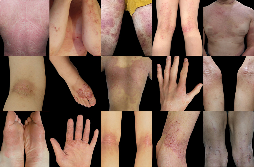 다양한 부위에 발병된 아토피 사례들