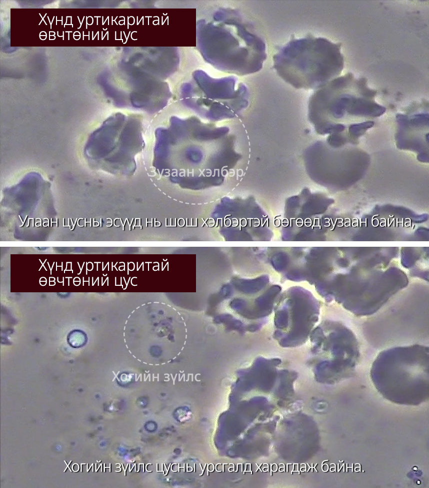 Хүнд Уртикаритай өвчтөний цус