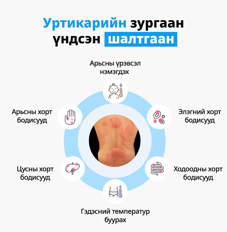 Уртикарийн зургаан үндсэн шалтгаан