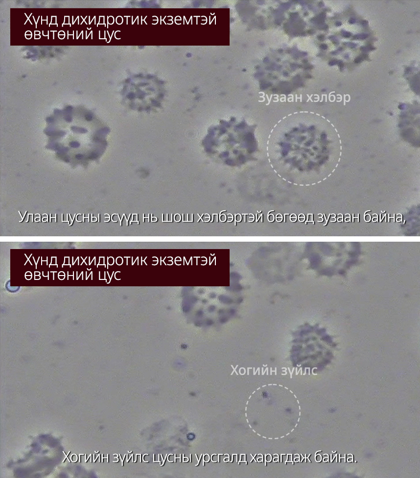 Хүнд Дихидротик экземтай өвчтөний цус