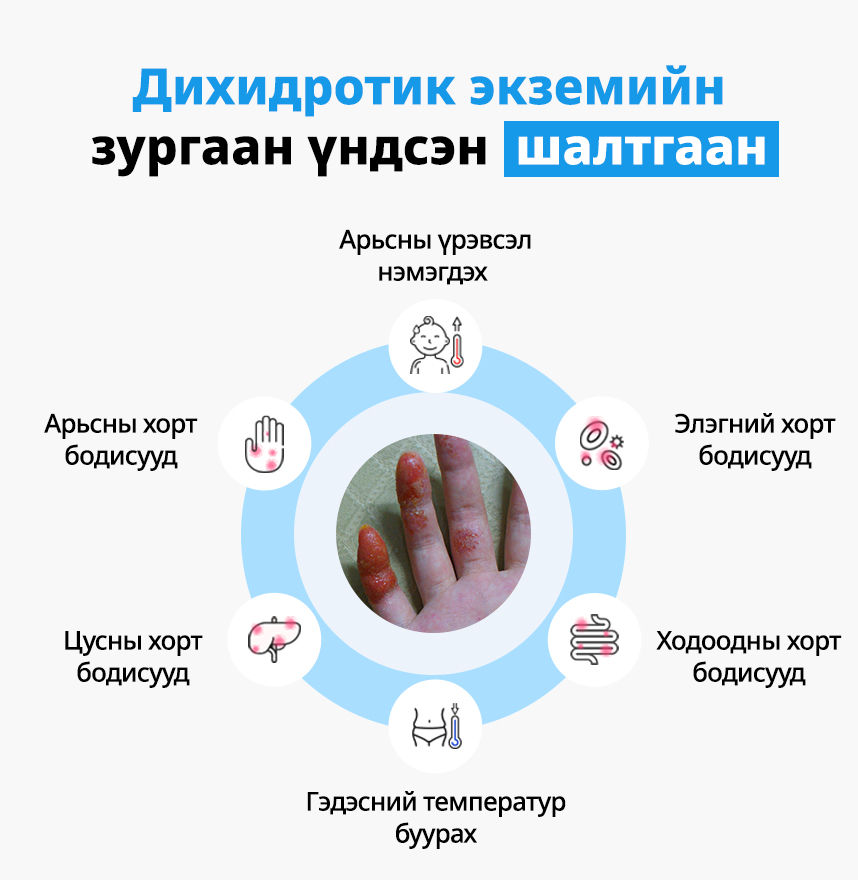Дихидротик экземийн зургаан үндсэн шалтгаан