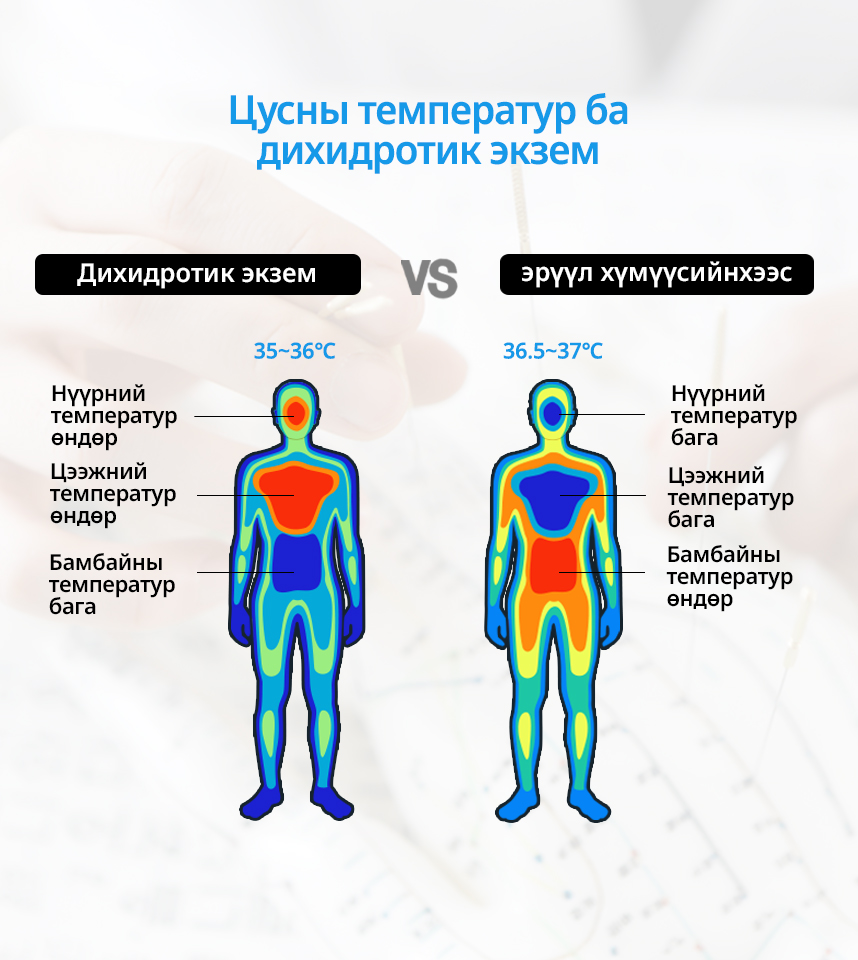 Цусны температур ба Дихидротик экзем
