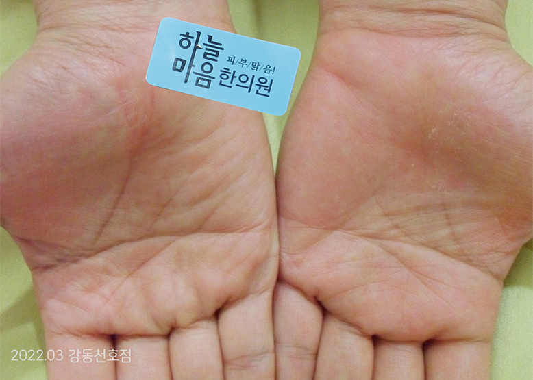 Дихидротик экземыг эмчилсний дараа