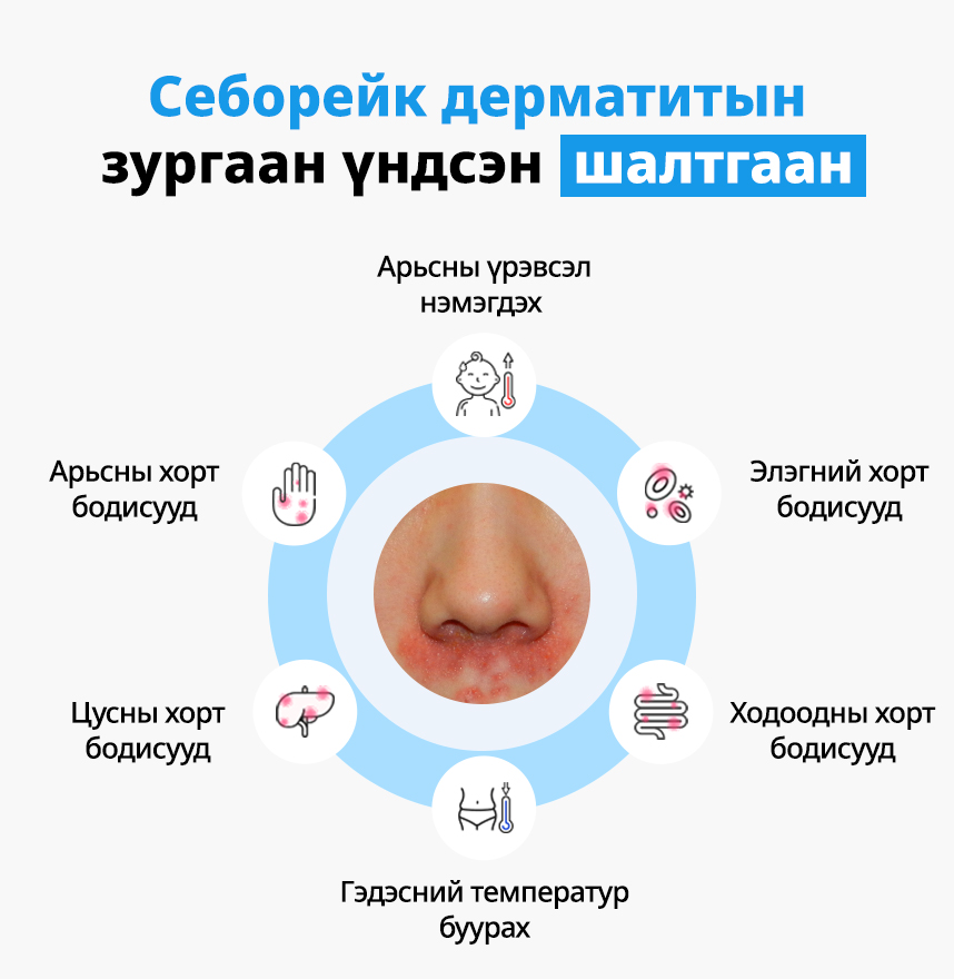 Себорейк дерматитын зургаан үндсэн шалтгаан
