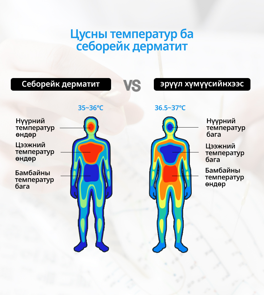 Цусны температур ба Себорейк дерматит