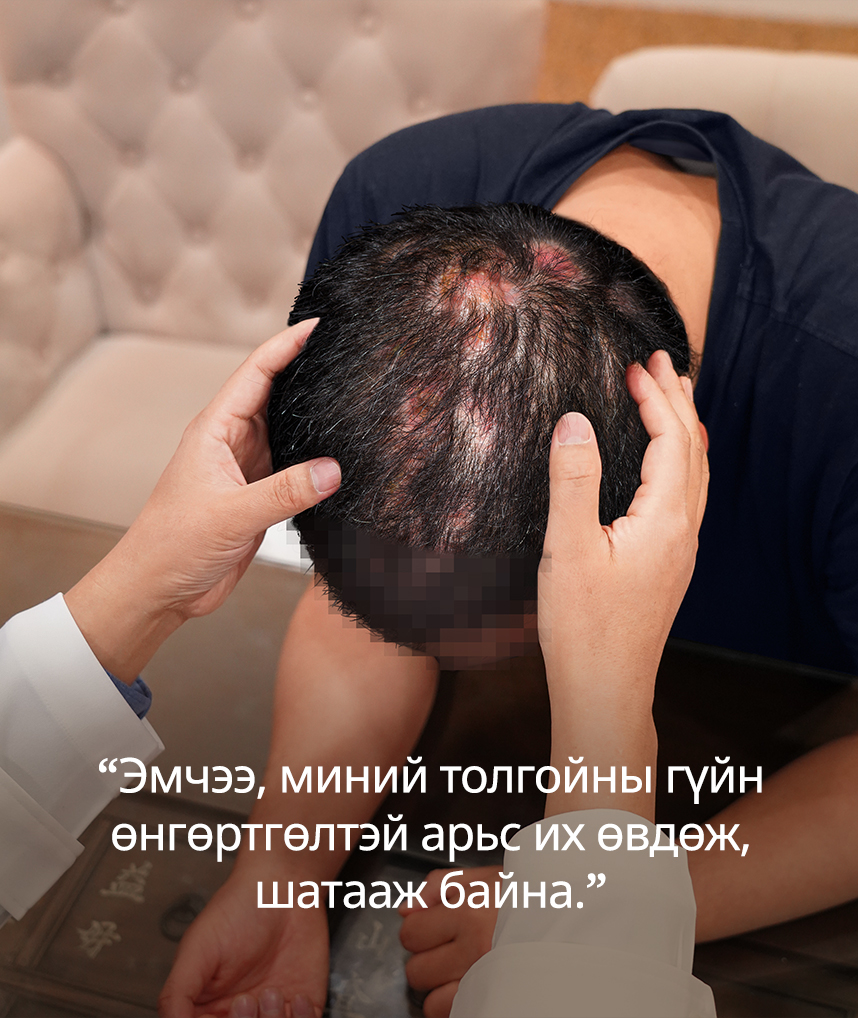 Эмчээ, миний толгойны гүйн өнгөртгөлтэй арьс их өвдөж, шатааж байна.