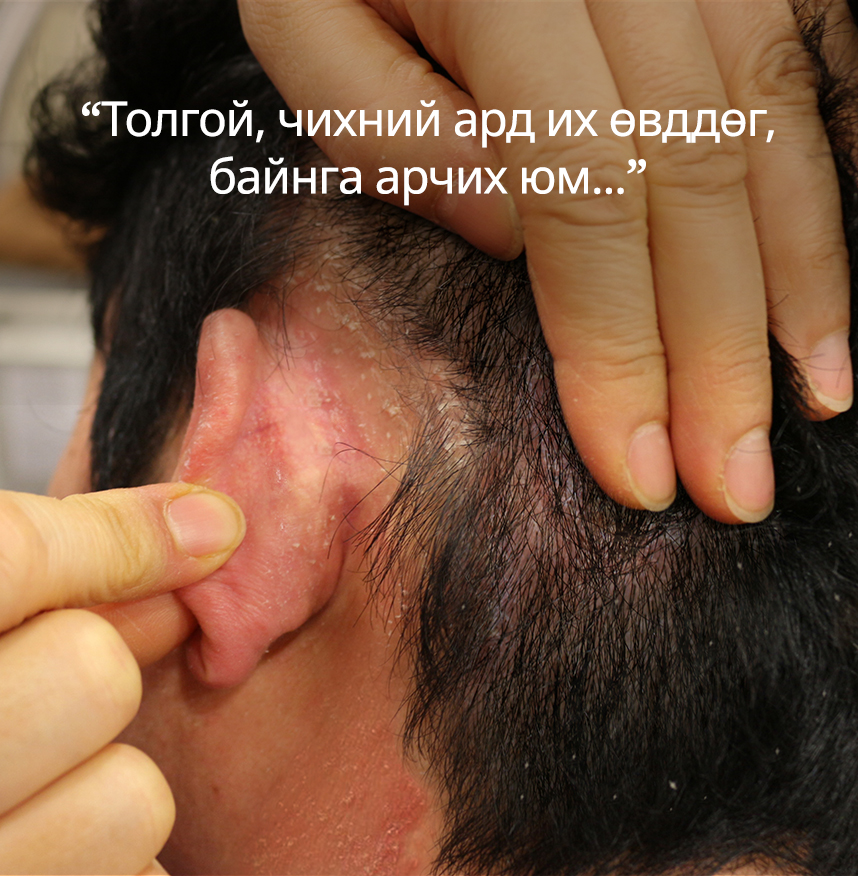 Толгой, чихний ард их өвддөг, байнга арчих юм...