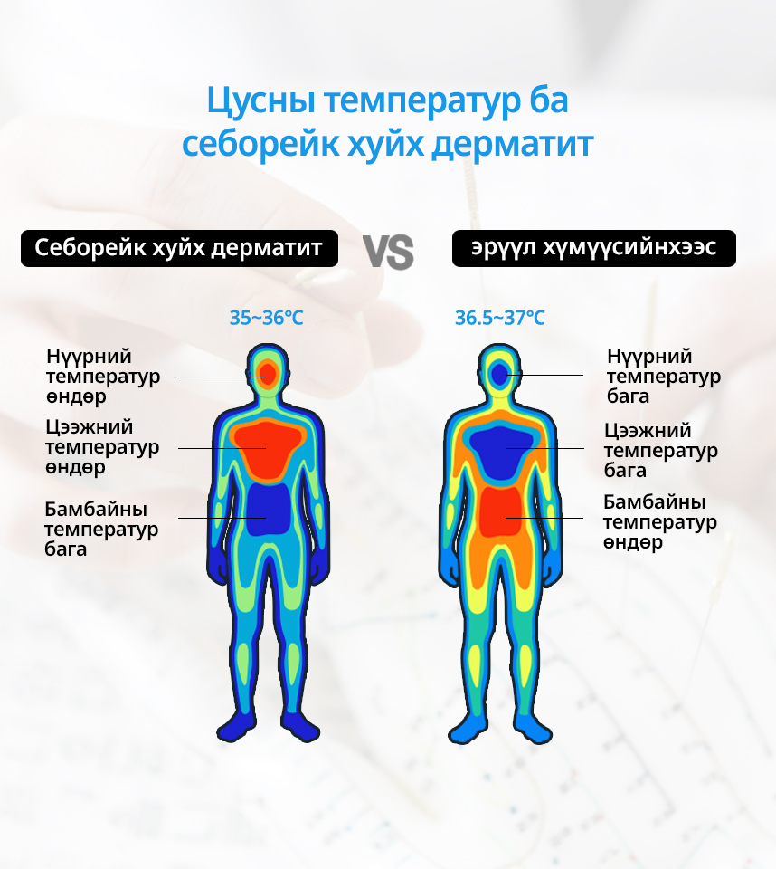 Цусны температур ба Себорейк хуйх дерматит