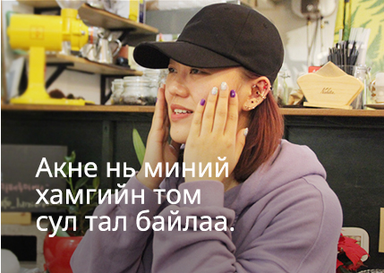 Акне нь миний хамгийн том сул тал байлаа.