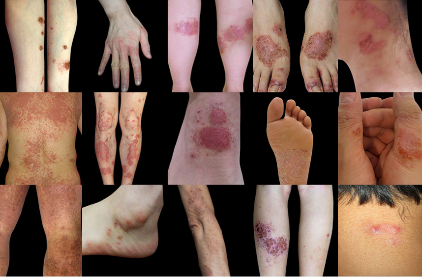 다양한 부위에 발병된 습진 사례들