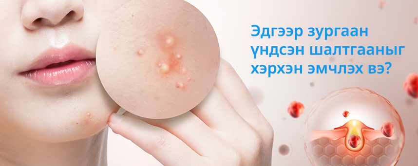 Эдгээр зургаан үндсэн шалтгааныг хэрхэн эмчлэх вэ?