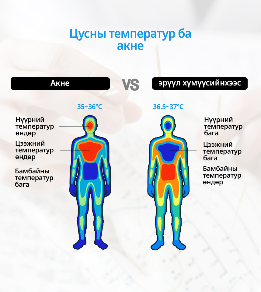 Центральная температура и акне