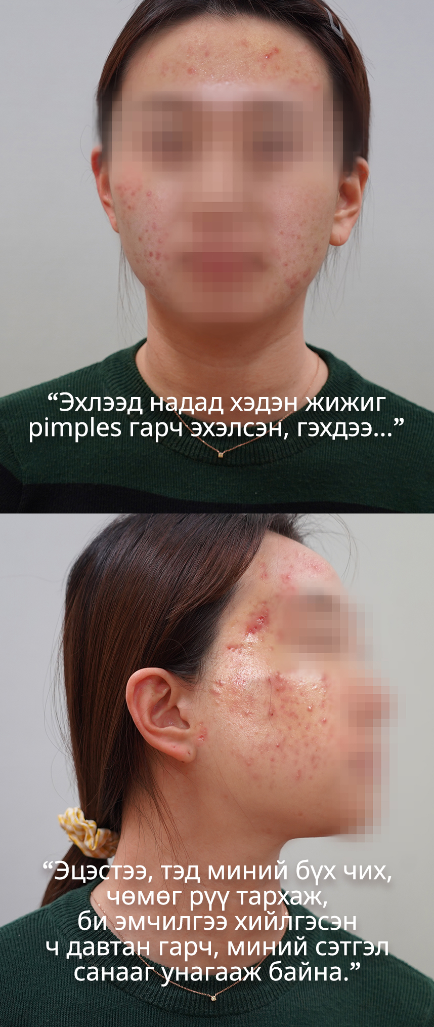 Эхлээд надад хэдэн жижиг pimples гарч эхэлсэн, гэхдээ...