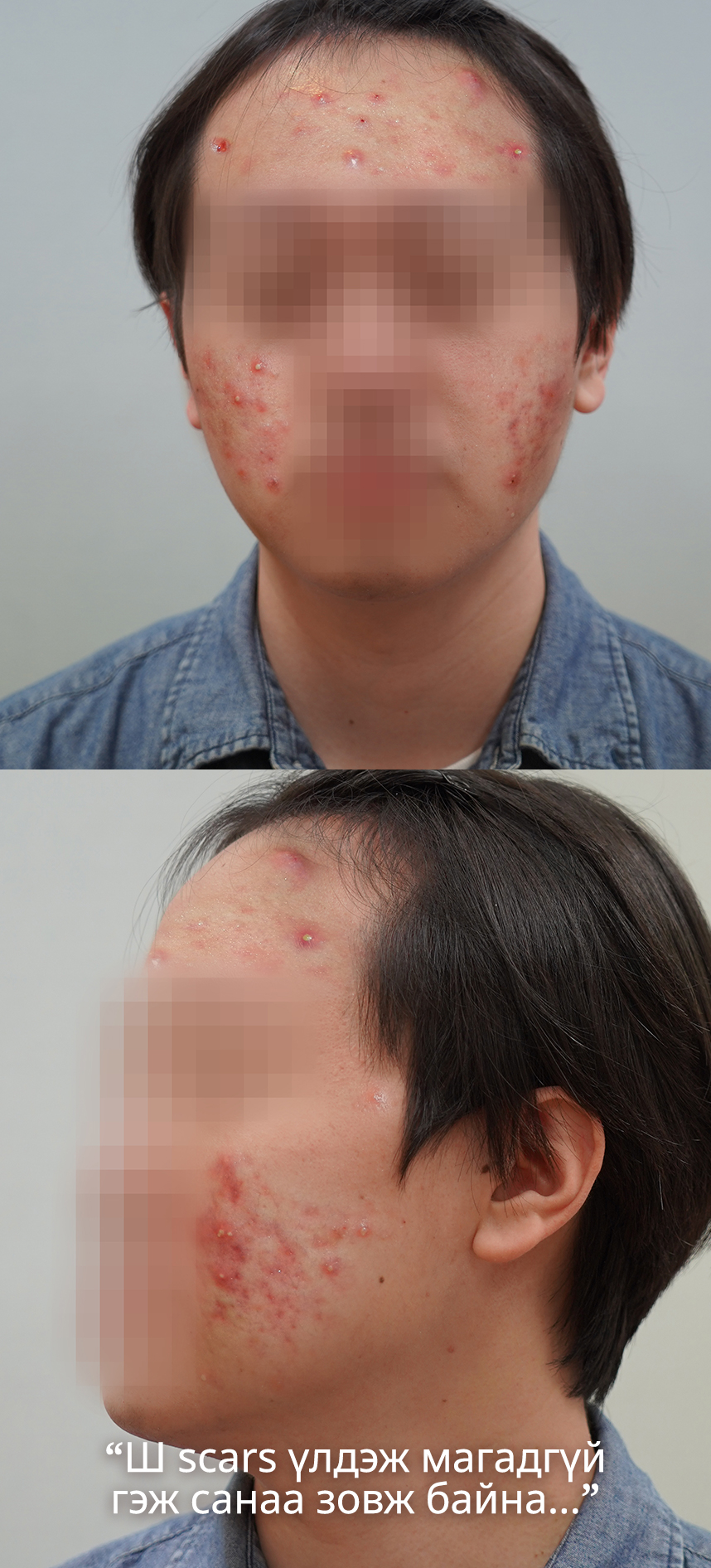 Ш scars үлдэж магадгүй гэж санаа зовж байна...
