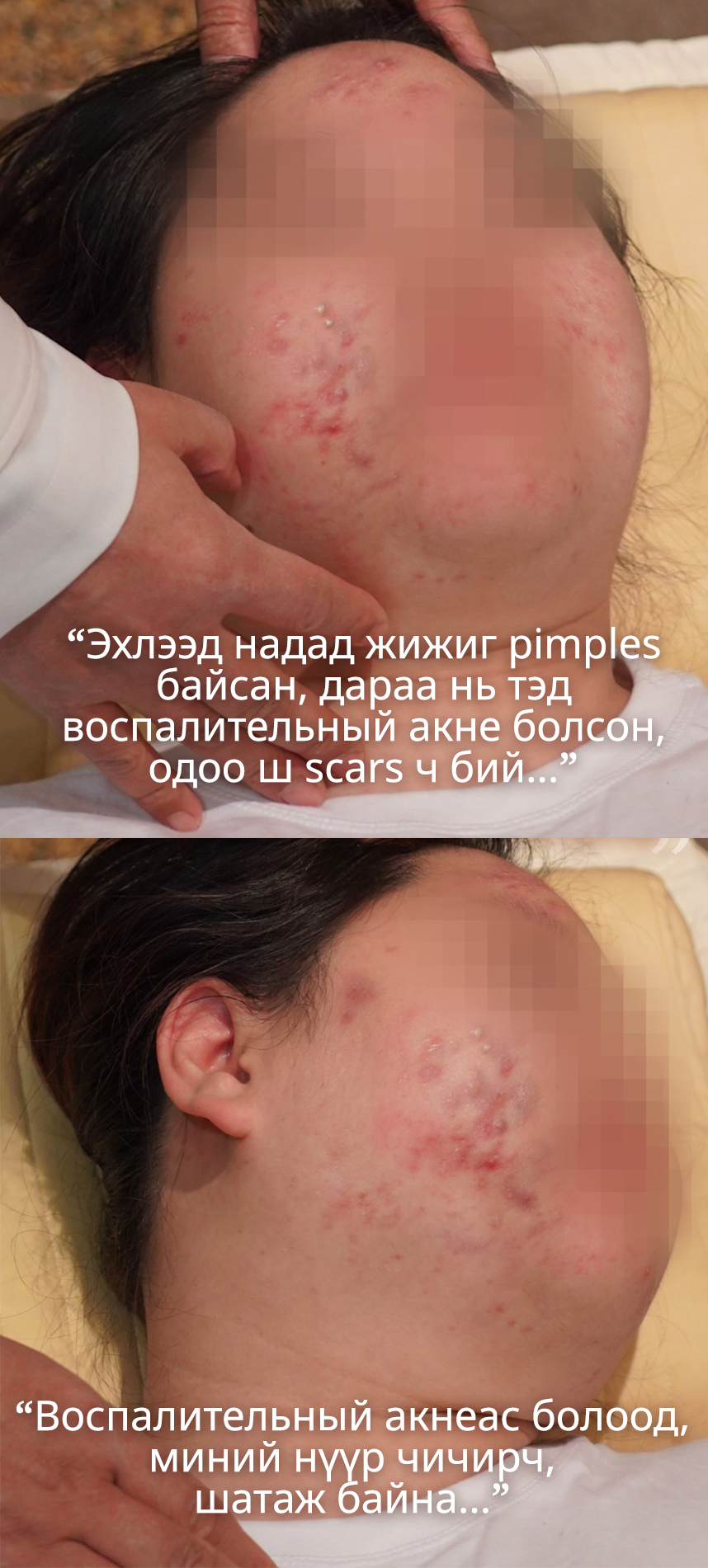 Эхлээд надад жижиг pimples байсан, дараа нь тэд воспалительный акне болсон, одоо ш scars ч бий...