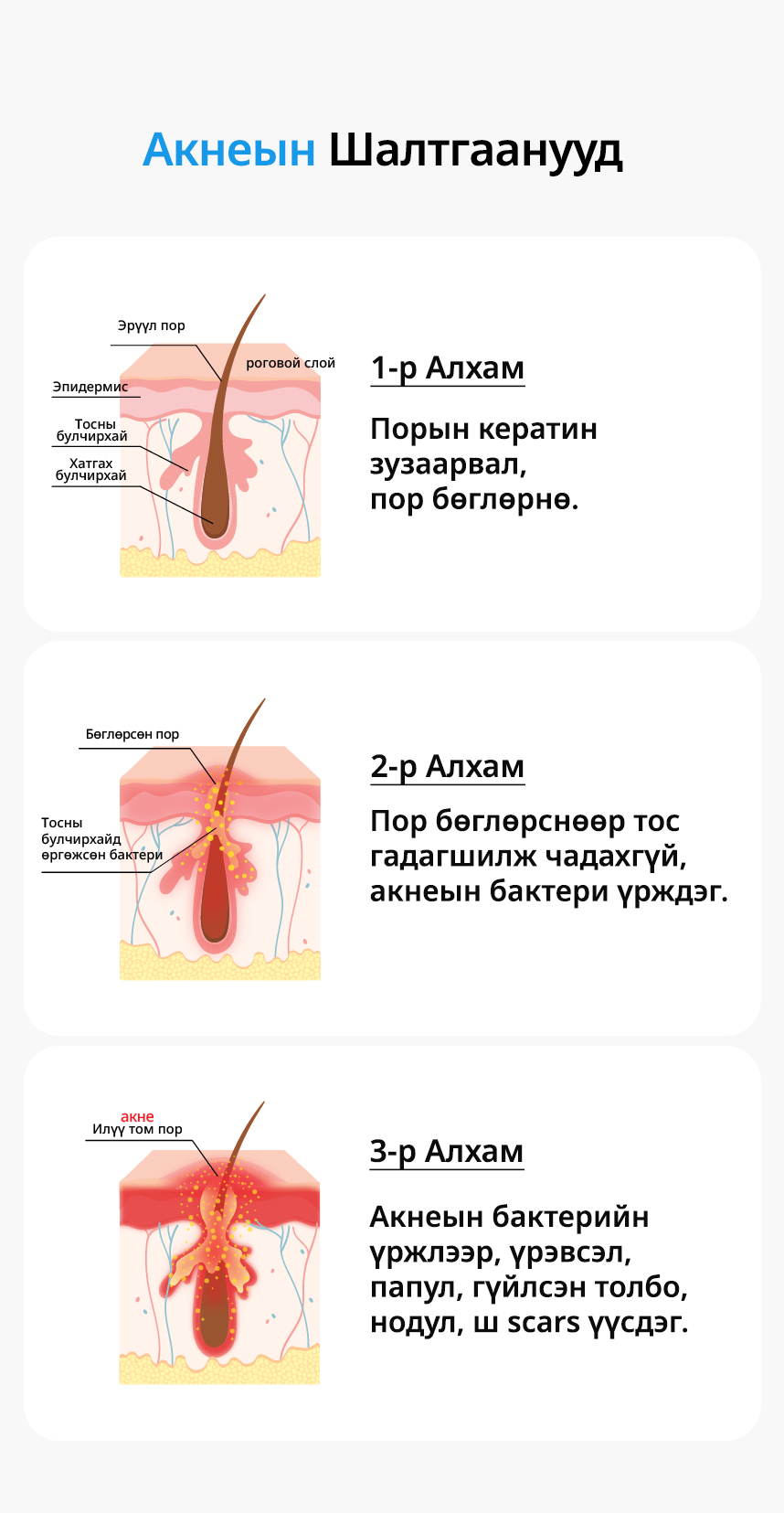 Причины акне