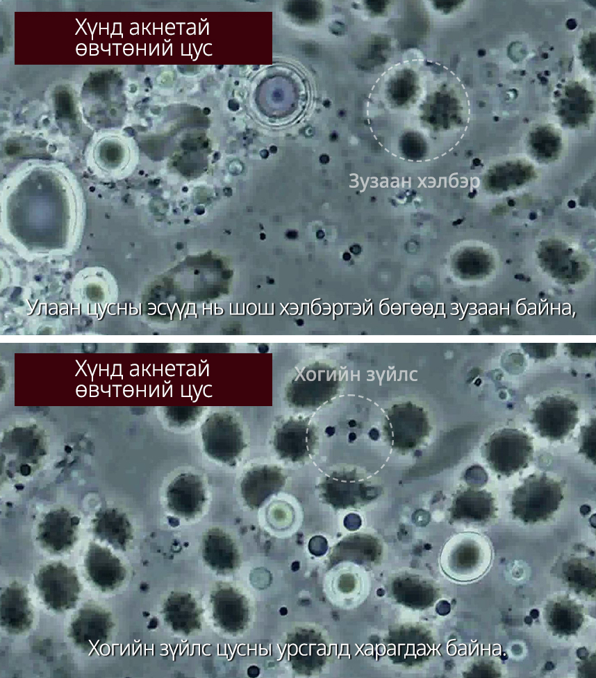 Хүнд акне өвчтэй өвчтөний цус