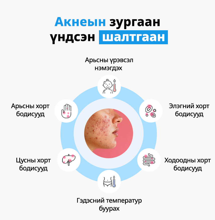 Акнеийн зургаан үндсэн шалтгаан