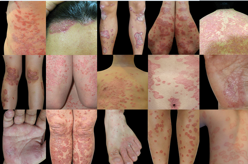 다양한 부위에 발병된 건선 사례들