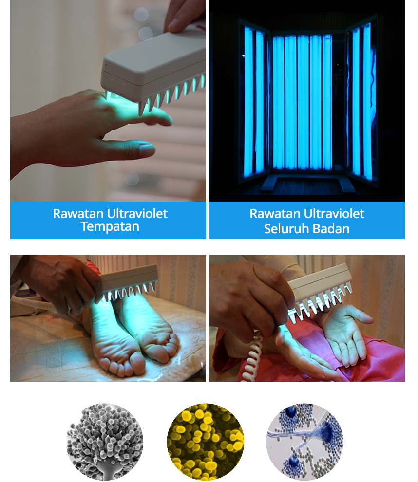 Rawatan Ultraviolet Tempatan, Rawatan Ultraviolet Seluruh Badan