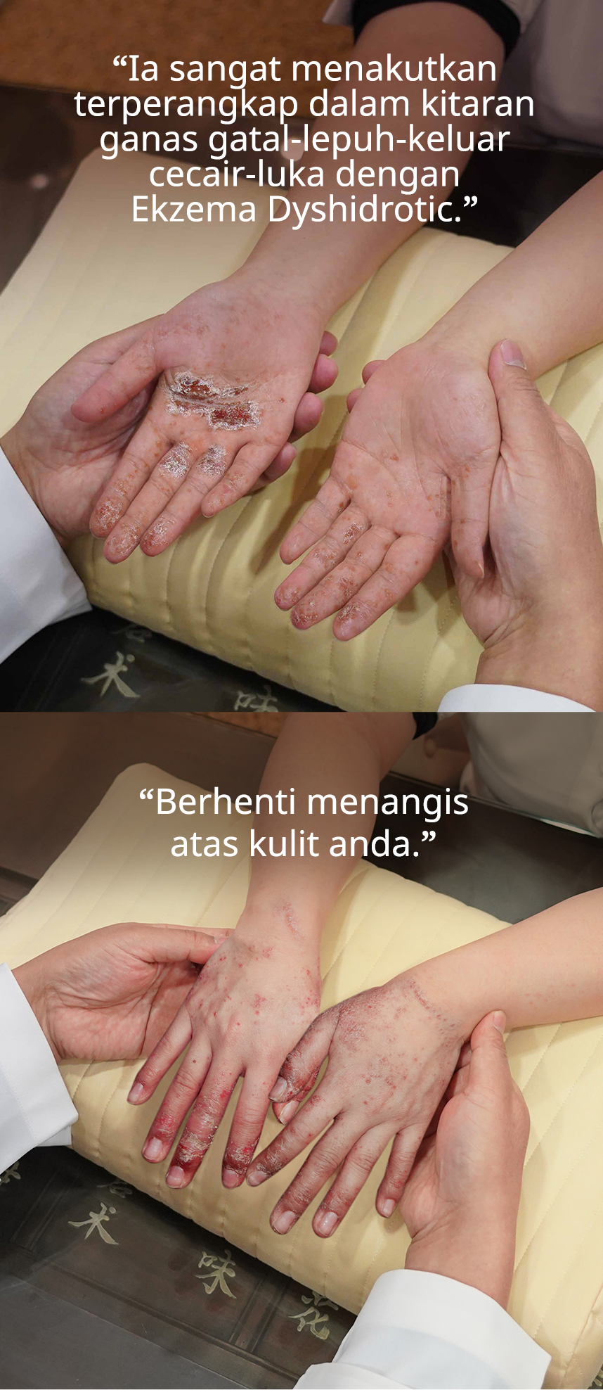 Ia sangat menakutkan terperangkap dalam kitaran ganas gatal-lepuh-keluar cecair-luka dengan Ekzema Dyshidrotic.