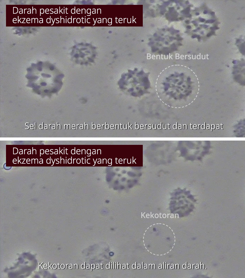 Darah pesakit dengan ekzema dyshidrotic yang teruk