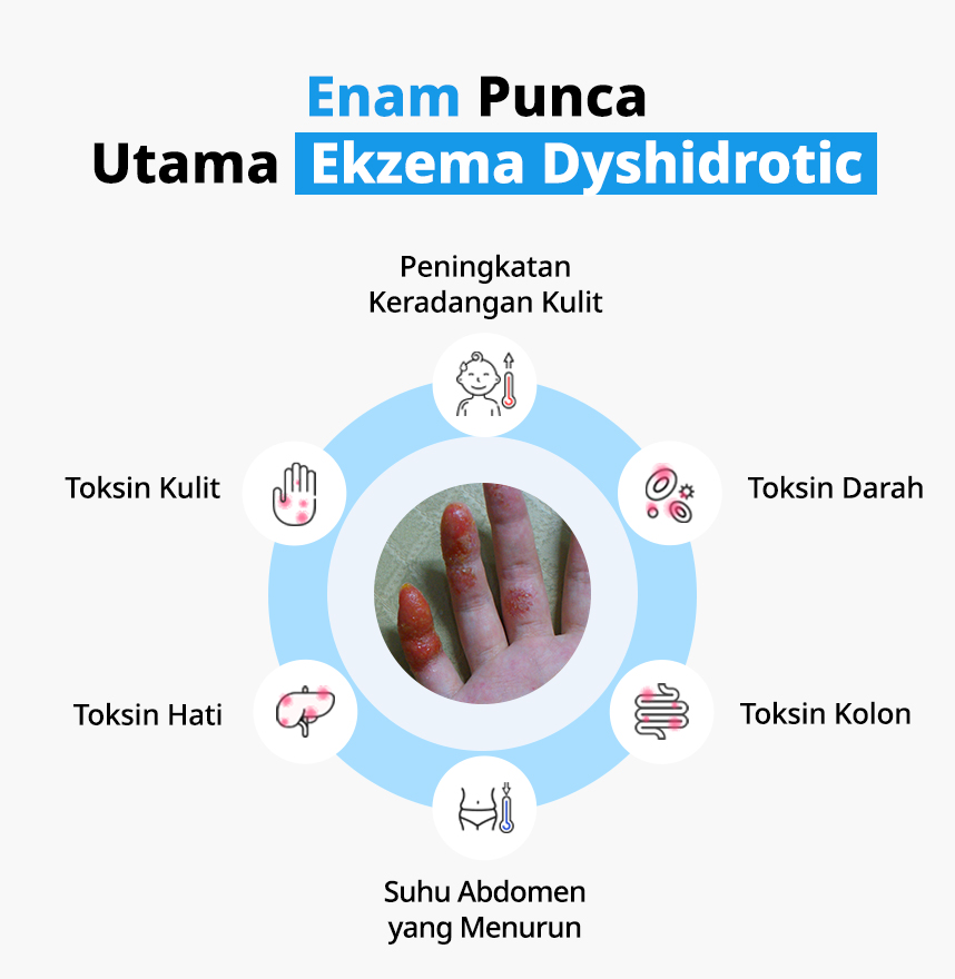 Enam Punca Utama ekzema dyshidrotic