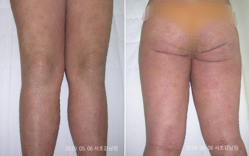 성인 아토피 병력 26년 여자